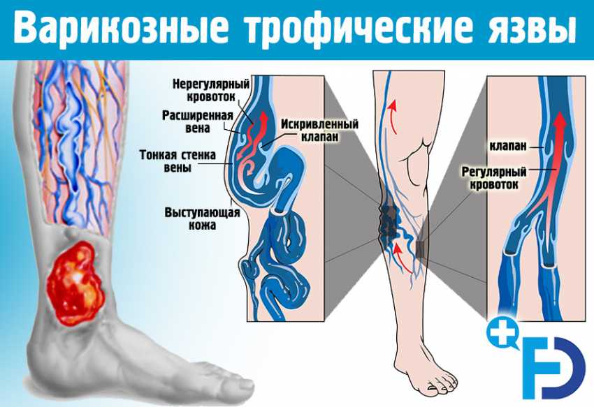 Вены На Ногах Горят Огнем