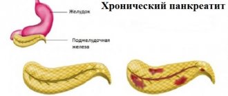 1) Healthy pancreas. 2) Inflammation of the pancreas. 