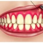 Gum abscess: causes, symptoms and treatment, North-Eastern Dental Center No. 1