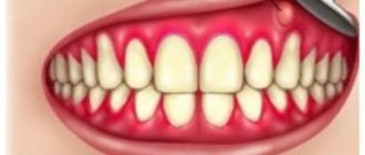 Gum abscess: causes, symptoms and treatment, North-Eastern Dental Center No. 1