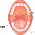 Sore throat and pharyngitis