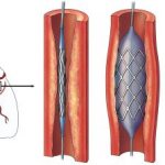 Angioplasty