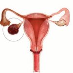 Ovarian apoplexy