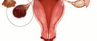 Ovarian apoplexy