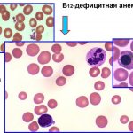 B12 анемия