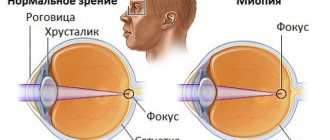 Близорукость (миопия) причины