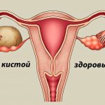 What is an ovarian cyst