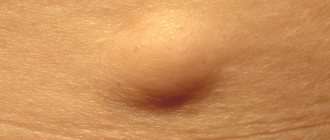 What is lipoma