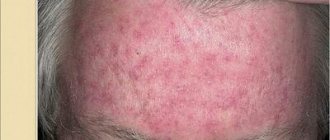 Dermatitis