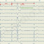 ECG