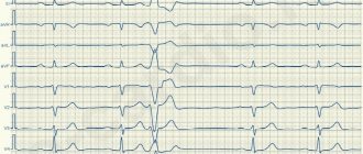 ECG