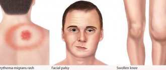 Erythema/facial paralysis/swollen knee