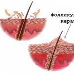 keratosis pilaris on the diagram