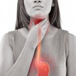 Gastroesophageal reflux disease