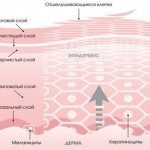 Hyperkeratosis