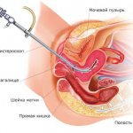 Hysteroscopy