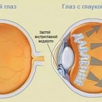 Глаукома глаза