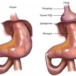 Hiatal hernia: causes, complaints, treatment