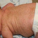 Ichthyosis