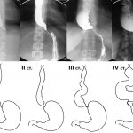 Classification of achalasia cardia