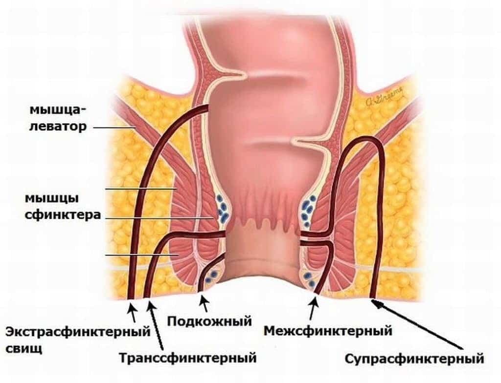 Аноректальный свищ – фистула