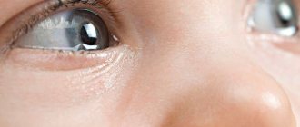 Conjunctivitis of the eyes in children