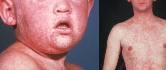Measles in children and adults - symptoms, prevention