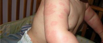 hives in a child photo