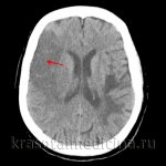 CT scan of the brain. Extensive ischemic stroke in the temporal and parietal lobes on the right 