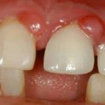 treatment of granuloma on a tooth