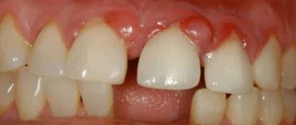 treatment of granuloma on a tooth