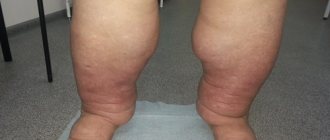 lymphedema photo