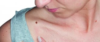 Skin melanoma