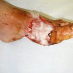 Local treatment of purulent wounds