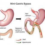 Mini gastric bypass