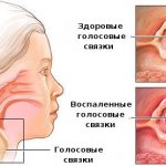 Ammonia-anise cough drops: how to take, instructions for use. How to drink for children and adults 