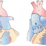 Surgery for aortic insufficiency