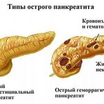 Acute pancreatitis