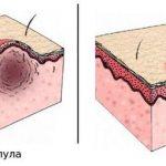 Papules and pustules