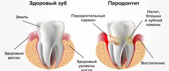 Periodontitis