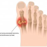 Gout Image 1 Network of clinics JSC Family Doctor