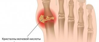 Подагра Изображение 1 Сеть клиник АО Семейный доктор