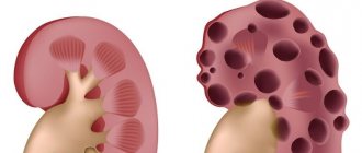 polycystic kidney disease