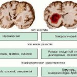 Brain damage due to stroke