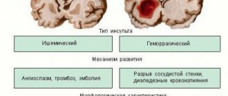 Повреждение мозга при инсульте