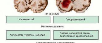 Brain damage due to stroke