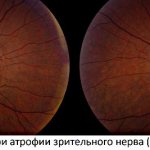 Causes and symptoms of optic nerve atrophy (OANA)