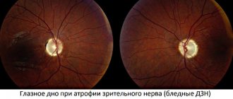 Причины и симптомы атрофии зрительного нерва глаза (ЧАЗН)
