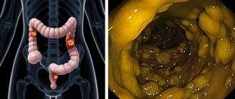 Pseudomembranous colitis