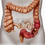 Sigmoid colon cancer